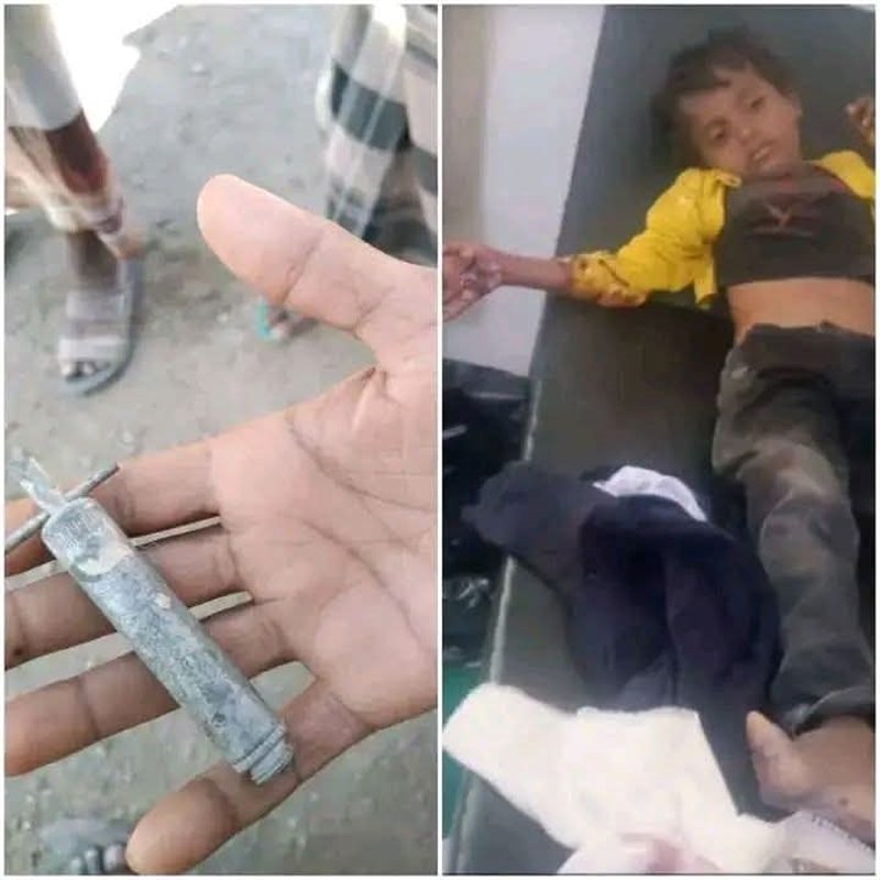 طفل يتعرض لإصابات خطرة جراء انفجار جسم متفجر من مخلفات الحرب في الوازعية بتعز